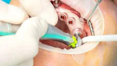 Implant Surgery