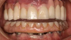 Occlusal Adjustment