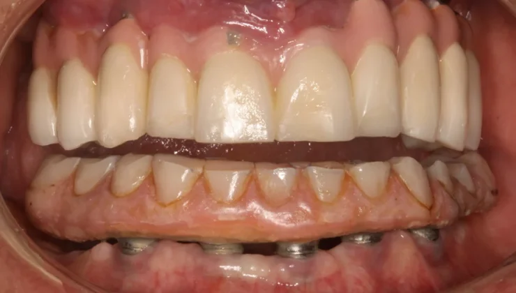 Occlusal Adjustment