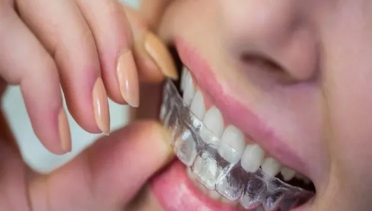 How Clear Aligners Support Better Oral Hygiene Habits