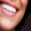 Veneer