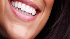 Veneer