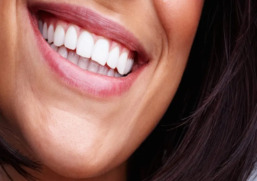 Achieving a Natural Smile With Modern Veneer Treatments
