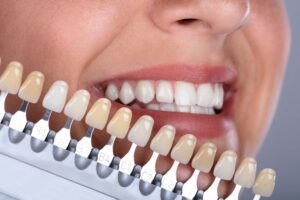 Top 10 London Cosmetic Dental Clinics for Composite Bonding